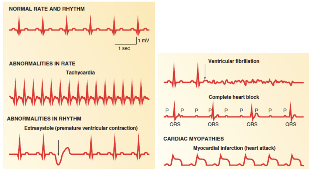 ECGS of patient with CVD