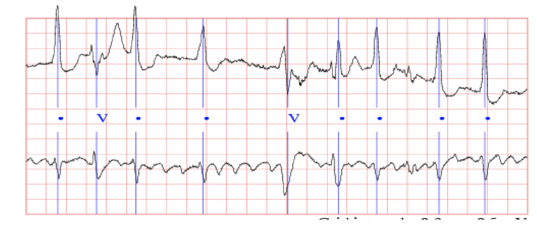 Sample data from the MIT-BIG arrhythmia database